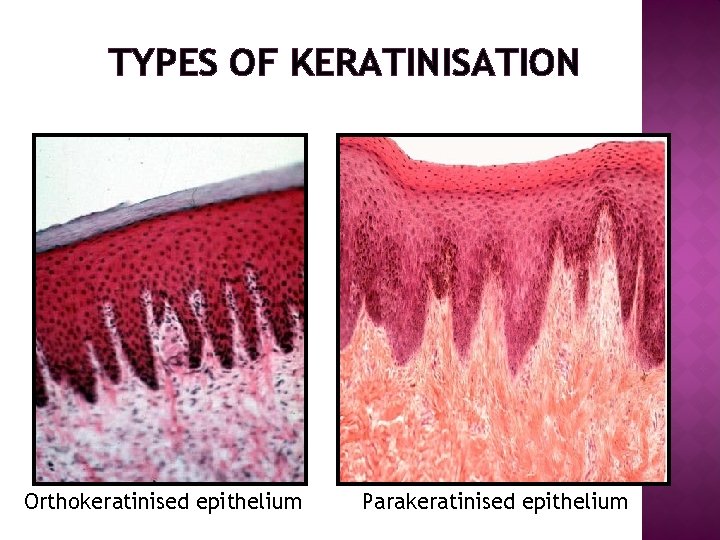 TYPES OF KERATINISATION Orthokeratinised epithelium Parakeratinised epithelium 