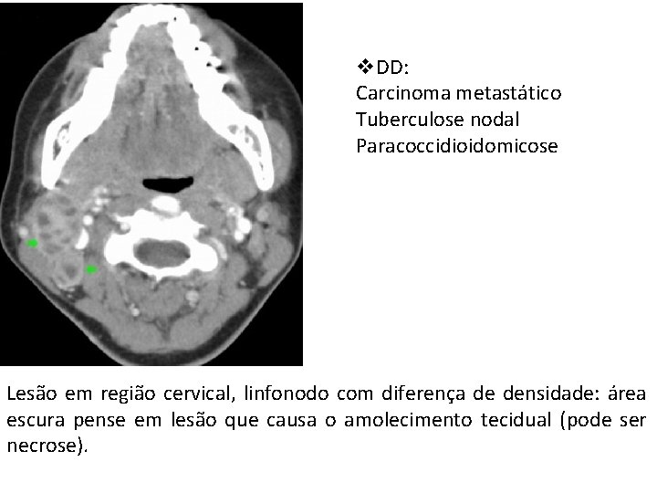 v. DD: Carcinoma metastático Tuberculose nodal Paracoccidioidomicose Lesão em região cervical, linfonodo com diferença