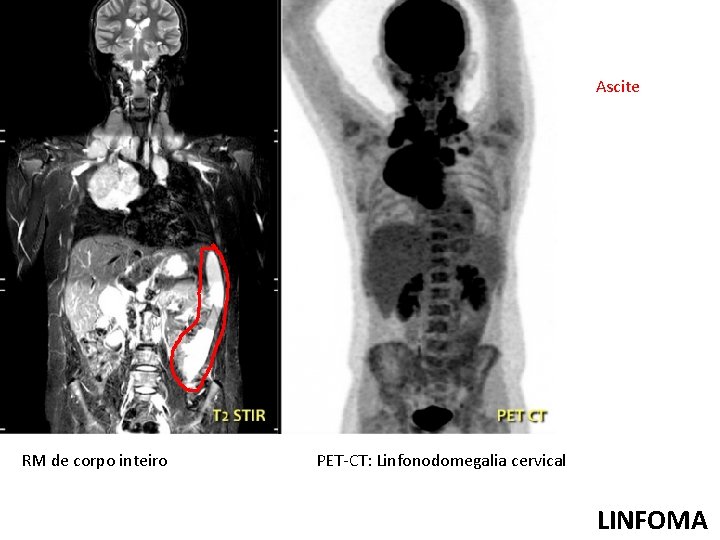 Ascite RM de corpo inteiro PET-CT: Linfonodomegalia cervical LINFOMA 