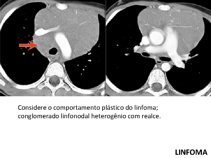 Considere o comportamento plástico do linfoma; conglomerado linfonodal heterogênio com realce. LINFOMA 