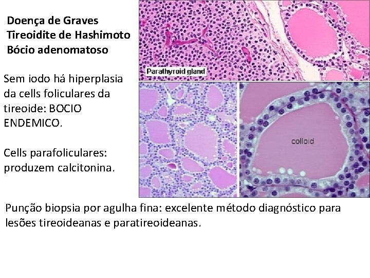 Doença de Graves Tireoidite de Hashimoto Bócio adenomatoso Sem iodo há hiperplasia da cells