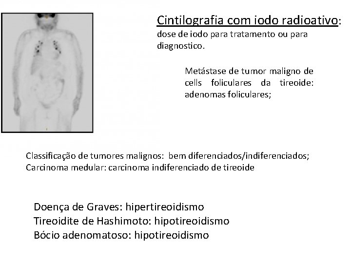 Cintilografia com iodo radioativo: dose de iodo para tratamento ou para diagnostico. Metástase de