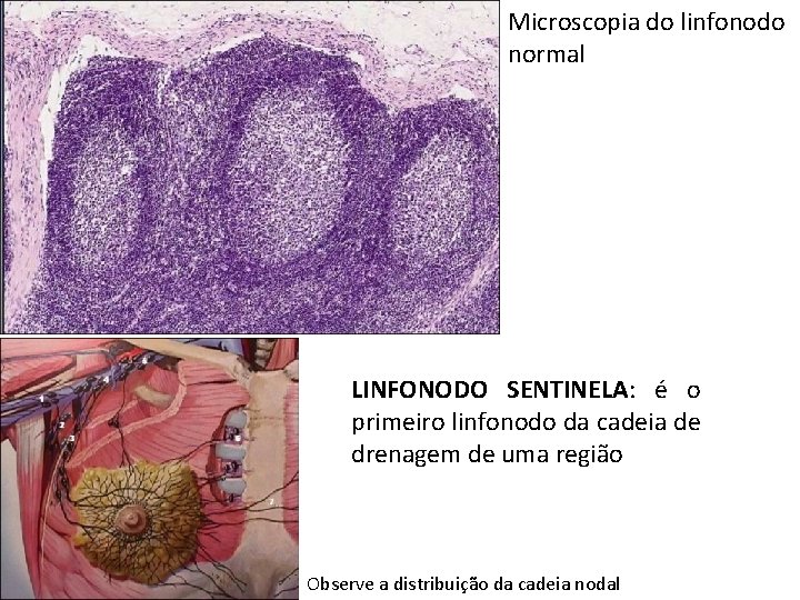 Microscopia do linfonodo normal LINFONODO SENTINELA: é o primeiro linfonodo da cadeia de drenagem