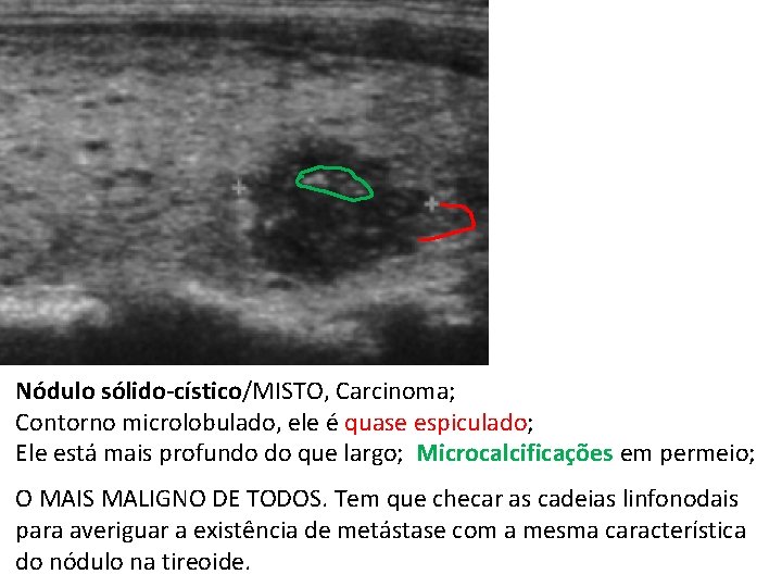 Nódulo sólido-cístico/MISTO, Carcinoma; Contorno microlobulado, ele é quase espiculado; Ele está mais profundo do