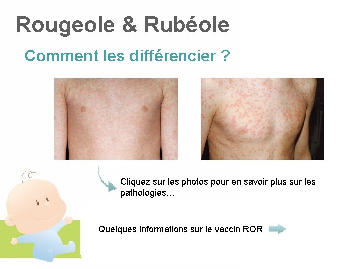 Rougeole & Rubéole Comment les différencier ? Cliquez sur les photos pour en savoir