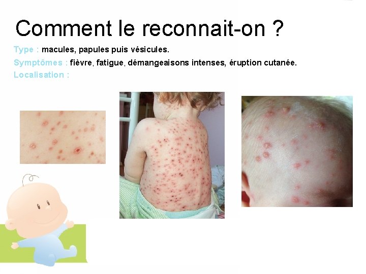 Comment le reconnait-on ? Type : macules, papules puis vésicules. Symptômes : fièvre, fatigue,