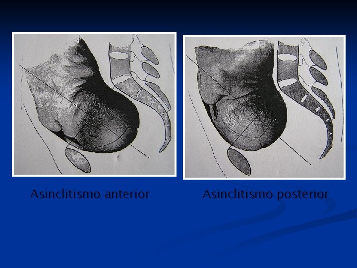 Asinclitismo anterior Asinclitismo posterior 