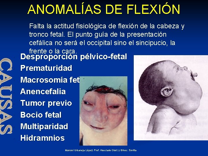 ANOMALÍAS DE FLEXIÓN • • Falta la actitud fisiológica de flexión de la cabeza
