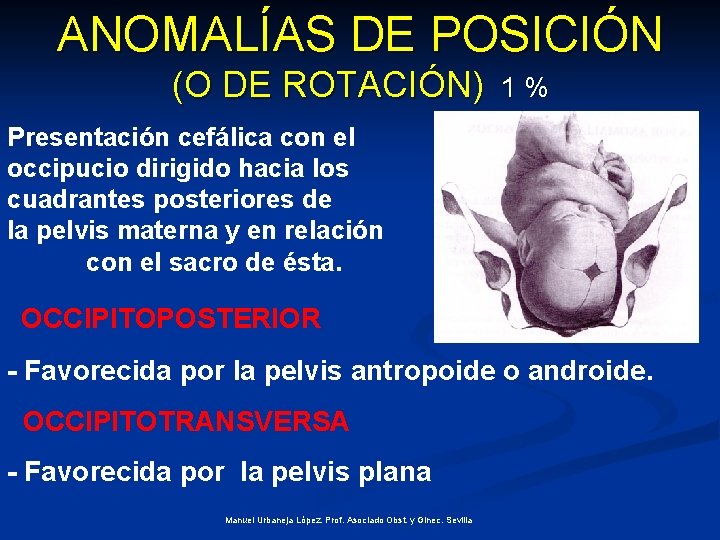 ANOMALÍAS DE POSICIÓN (O DE ROTACIÓN) 1% Presentación cefálica con el occipucio dirigido hacia