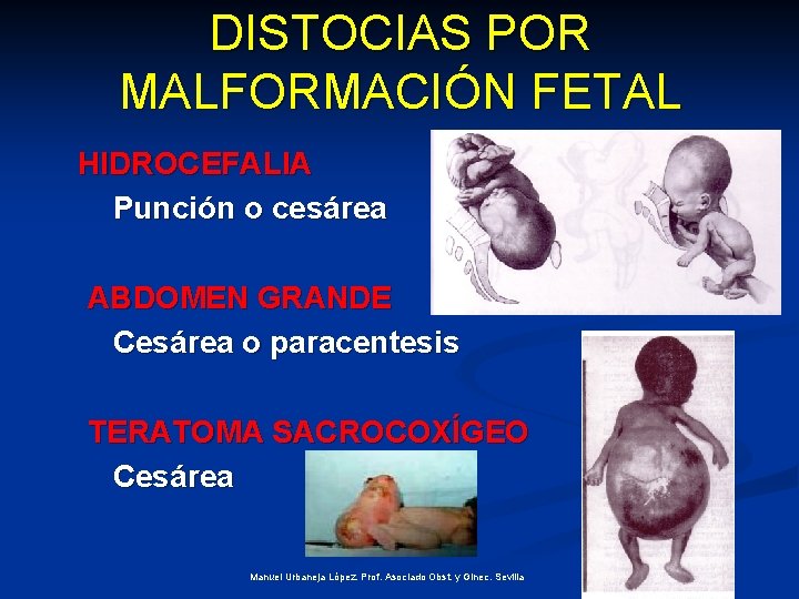 DISTOCIAS POR MALFORMACIÓN FETAL HIDROCEFALIA Punción o cesárea ABDOMEN GRANDE Cesárea o paracentesis TERATOMA