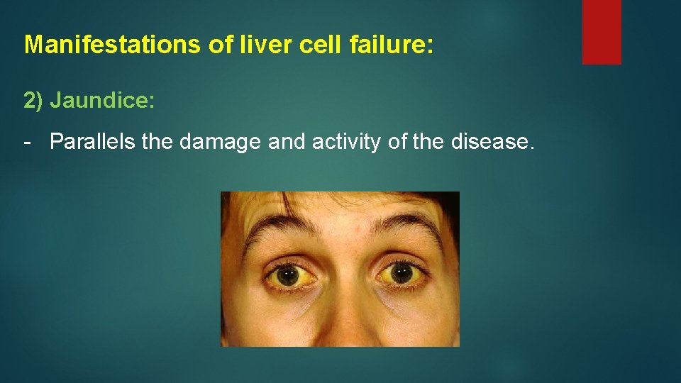 Manifestations of liver cell failure: 2) Jaundice: - Parallels the damage and activity of