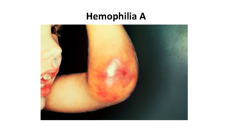 Hemophilia A 