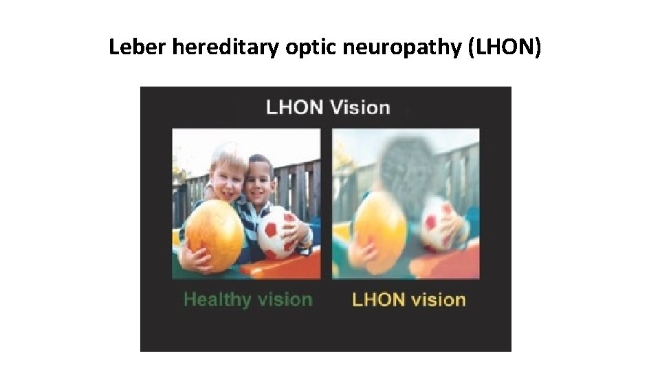 Leber hereditary optic neuropathy (LHON) 