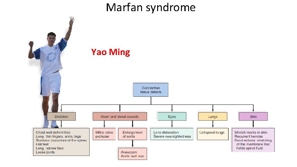 Marfan syndrome Yao Ming 