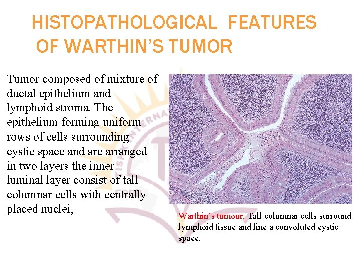 HISTOPATHOLOGICAL FEATURES OF WARTHIN’S TUMOR Tumor composed of mixture of ductal epithelium and lymphoid