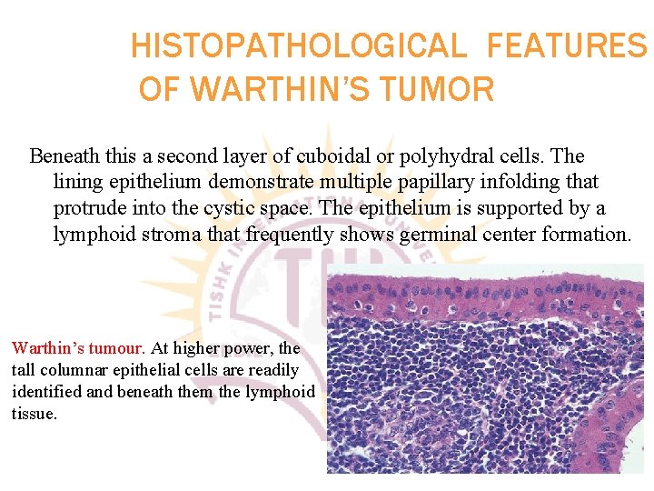 HISTOPATHOLOGICAL FEATURES OF WARTHIN’S TUMOR Beneath this a second layer of cuboidal or polyhydral