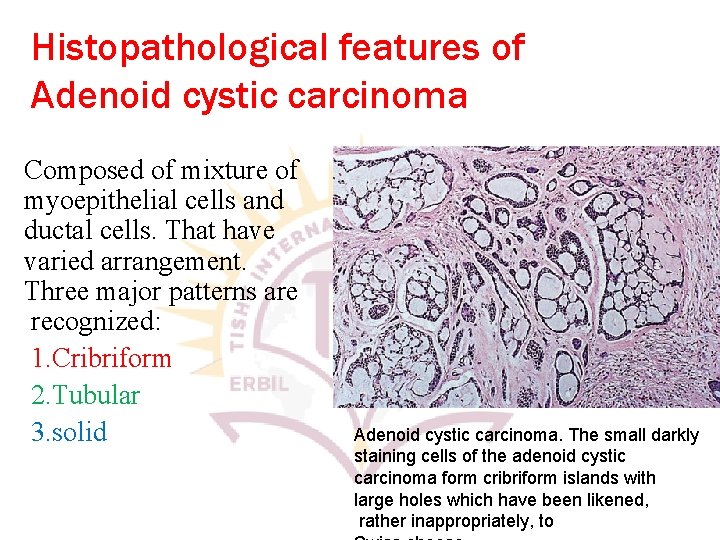Histopathological features of Adenoid cystic carcinoma Composed of mixture of myoepithelial cells and ductal