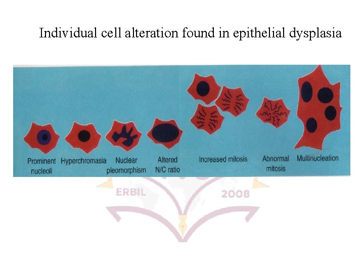 Individual cell alteration found in epithelial dysplasia 