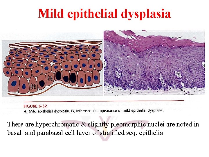 Mild epithelial dysplasia There are hyperchromatic & slightly pleomorphic nuclei are noted in basal