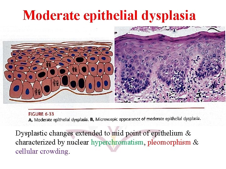 Moderate epithelial dysplasia Dysplastic changes extended to mid point of epithelium & characterized by