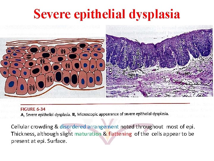 Severe epithelial dysplasia Cellular crowding & disordered arrangement noted throughout most of epi. Thickness,