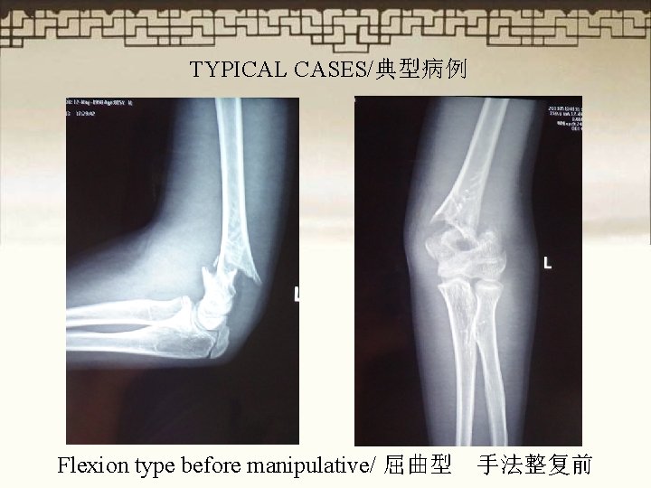 TYPICAL CASES/典型病例 Flexion type before manipulative/ 屈曲型 手法整复前 