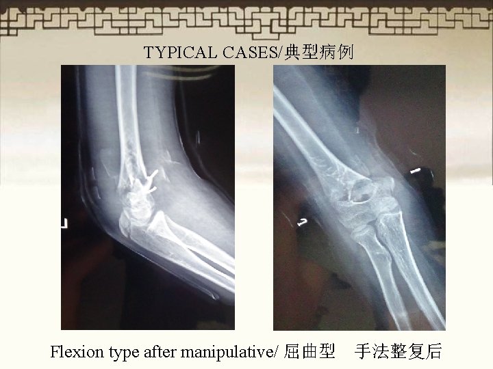 TYPICAL CASES/典型病例 Flexion type after manipulative/ 屈曲型 手法整复后 
