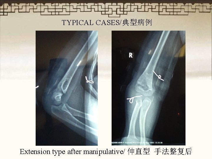 TYPICAL CASES/典型病例 Extension type after manipulative/ 伸直型 手法整复后 