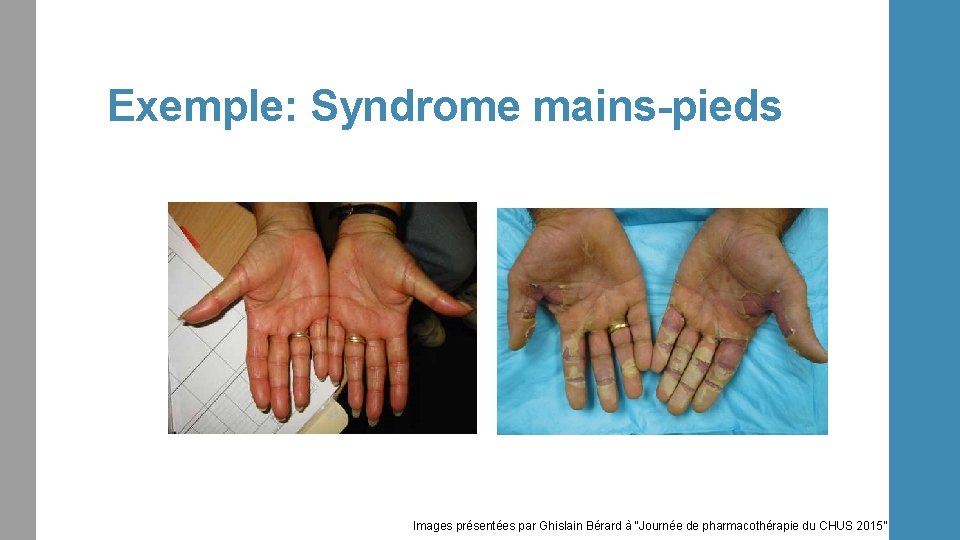 Exemple: Syndrome mains-pieds Images présentées par Ghislain Bérard à “Journée de pharmacothérapie du CHUS