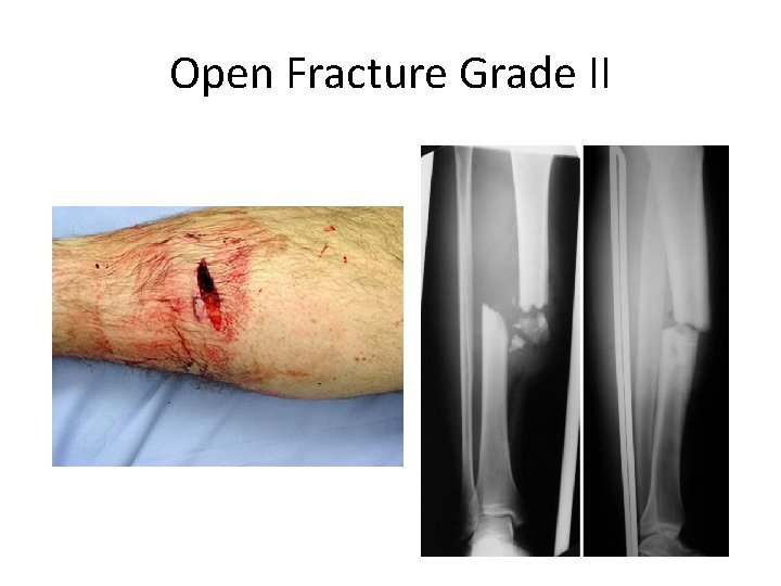 Open Fracture Grade II 