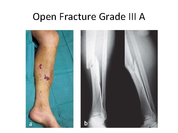 Open Fracture Grade III A 