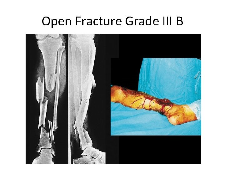 Open Fracture Grade III B 