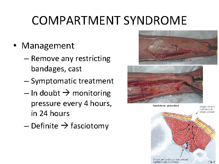 COMPARTMENT SYNDROME • Management – Remove any restricting bandages, cast – Symptomatic treatment –