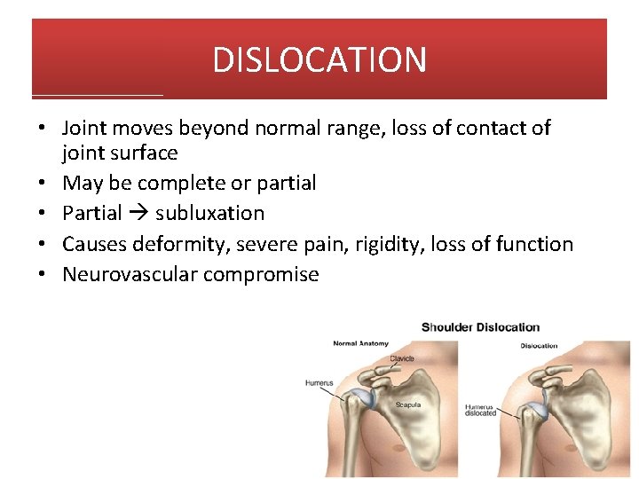 DISLOCATION • Joint moves beyond normal range, loss of contact of joint surface •