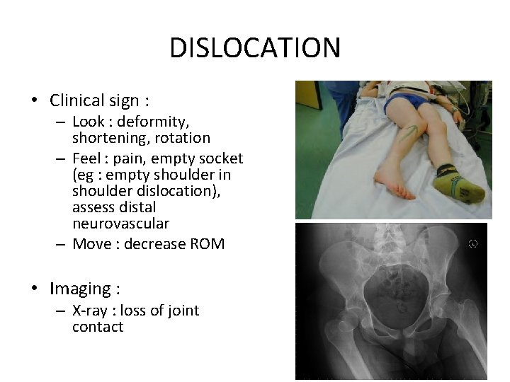 DISLOCATION • Clinical sign : – Look : deformity, shortening, rotation – Feel :