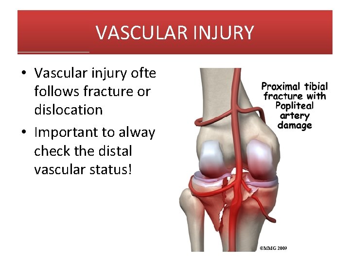 VASCULAR INJURY • Vascular injury often follows fracture or dislocation • Important to always