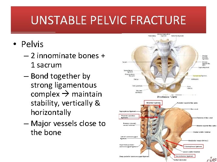 UNSTABLE PELVIC FRACTURE • Pelvis – 2 innominate bones + 1 sacrum – Bond