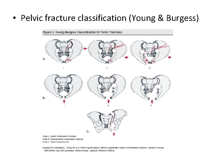  • Pelvic fracture classification (Young & Burgess) 