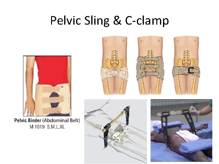 Pelvic Sling & C-clamp 