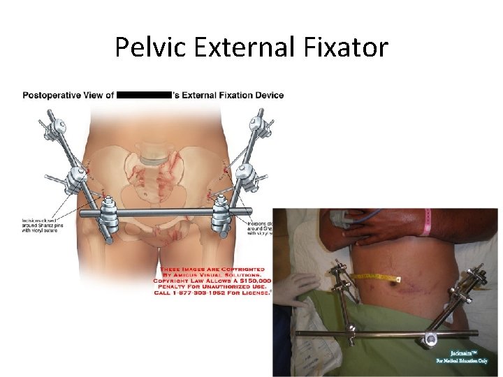 Pelvic External Fixator 