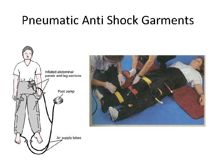 Pneumatic Anti Shock Garments 