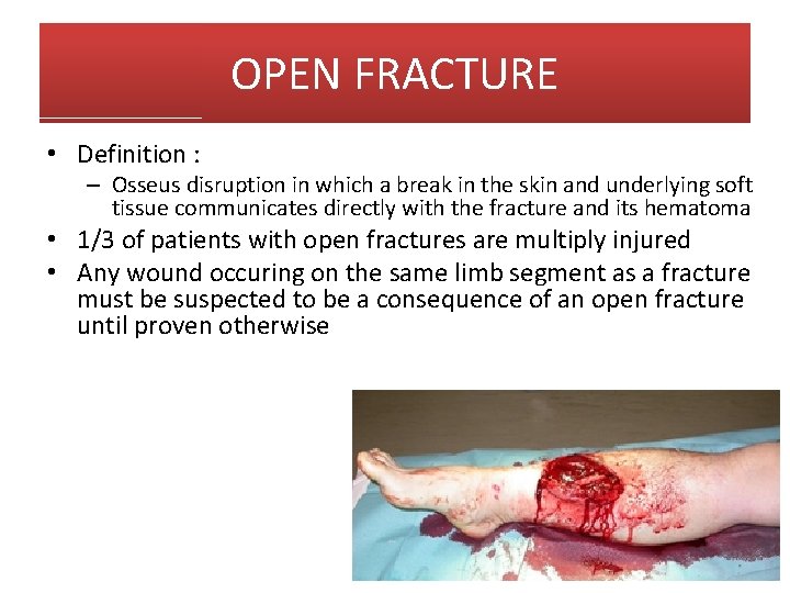 OPEN FRACTURE • Definition : – Osseus disruption in which a break in the