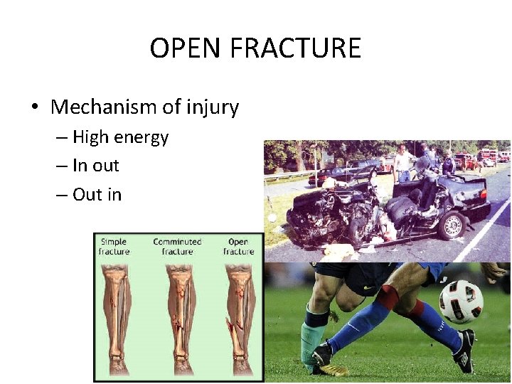 OPEN FRACTURE • Mechanism of injury – High energy – In out – Out