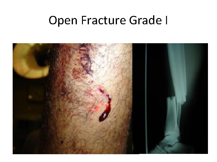Open Fracture Grade I 