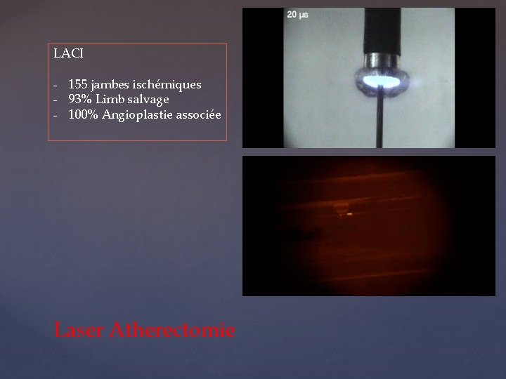 LACI - 155 jambes ischémiques - 93% Limb salvage - 100% Angioplastie associée Laser