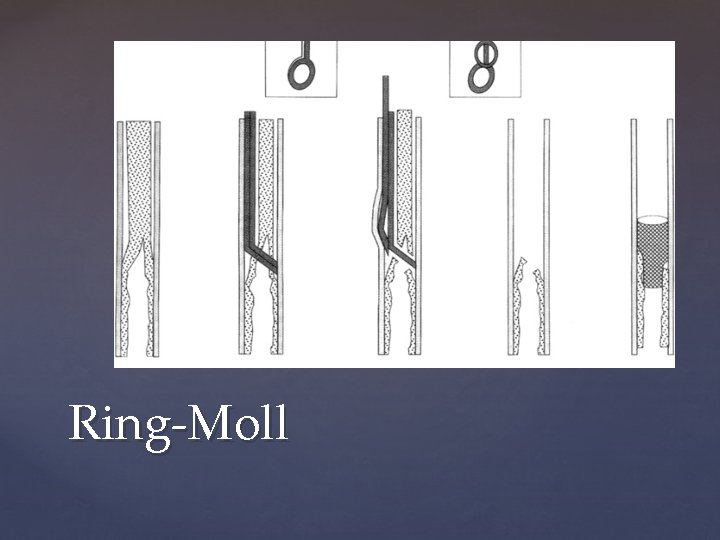 Ring-Moll 