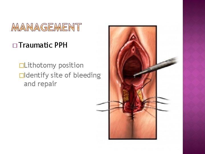 � Traumatic PPH �Lithotomy position �Identify site of bleeding and repair 