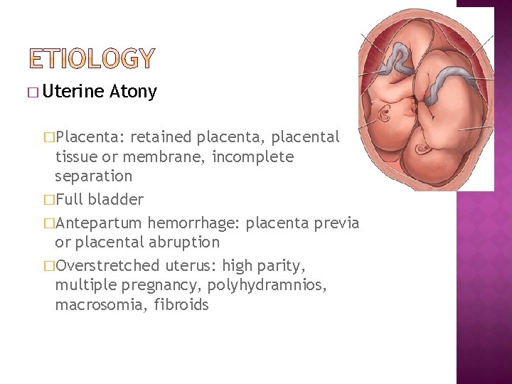 � Uterine Atony �Placenta: retained placenta, placental tissue or membrane, incomplete separation �Full bladder