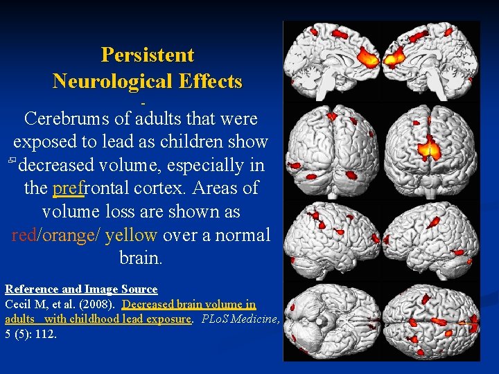 Persistent Neurological Effects Cerebrums of adults that were exposed to lead as children show Persistent Neurological Effects Cerebrums of adults that were exposed to lead as children show