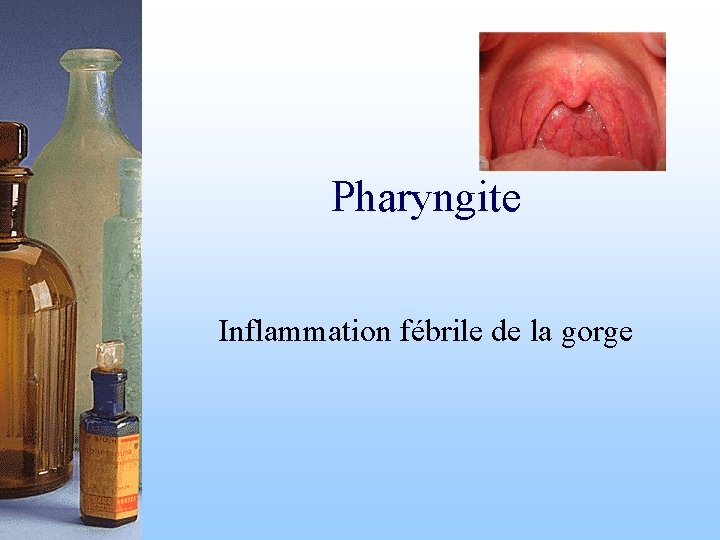 Pharyngite Inflammation fébrile de la gorge 